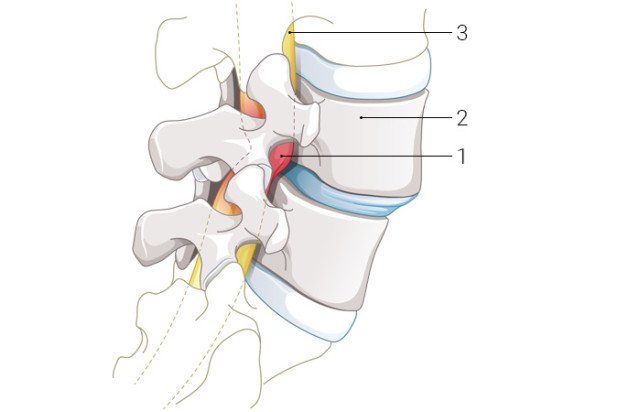 Anatomie verengter Spinalkanal
