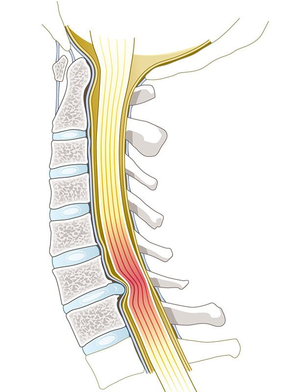 Zervikale spondylotische Myelopathi