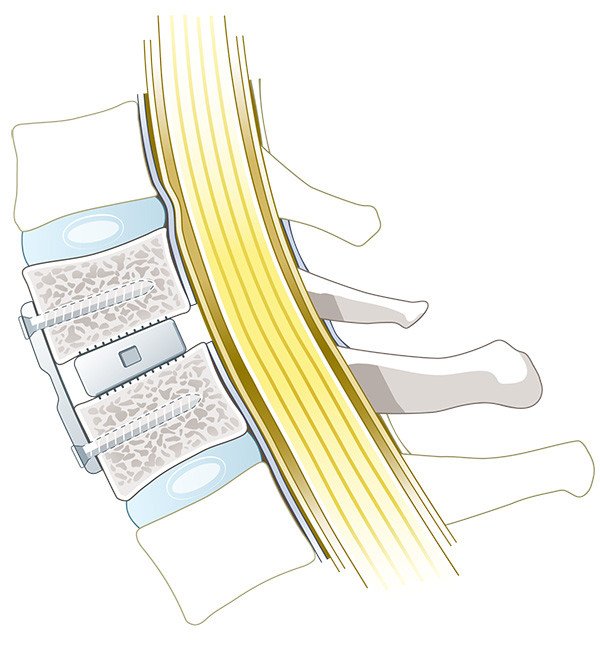Dekompression Wirbelkanal