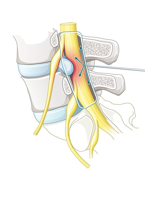 Epidurale interlaminäre Infiltration