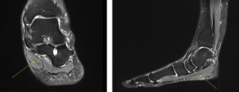 2 MRI-Bilder des Musculus abductor hallucis