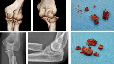 CT-Untersuchung mit 3-D-Rekonstruktion, Resektion des Radiuskopfes