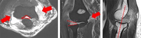 MRI-Bilder Kapselbandläsion Ellbogen