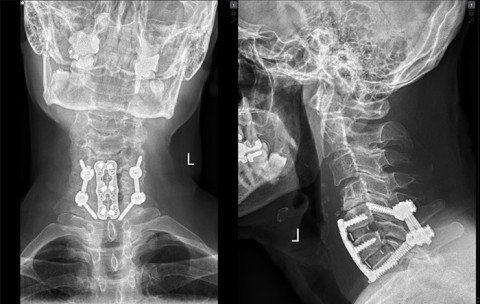 postoperative Röntgenbilder der Halswirbelsäule mit verschraubbare Platte