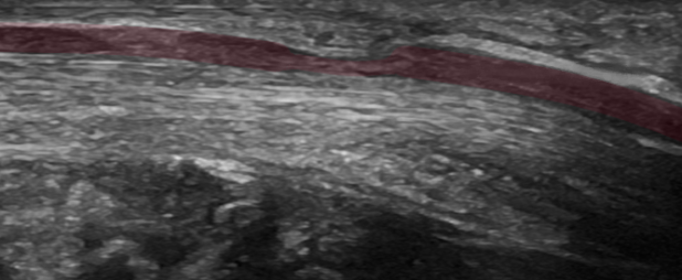 N. medianus mit kurzstreckiger, sanduhrförmiger Einengung.