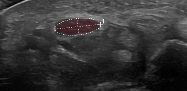 N. medianus im Querschnitt vor Eintritt in der Karpalkanal mit deutlicher Vergrösserung der Fläche auf 19.50 mm² (interne Normwerte ≤11 mm²) und aufgehobener faszikulärer Struktur.
