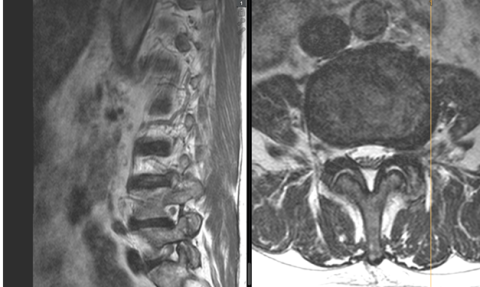 MRI extrem seitlichen Bandscheibenvorfall
