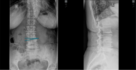 Coronal Segmental Cobb Angle (CSCA): Winkel zwischen der unteren Endplatte des superioren Wirbels und der oberen Endplatte des inferioren Wirbels.