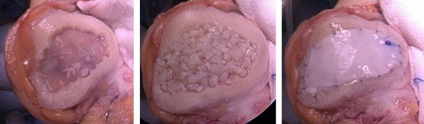 Retropatellarer Knorpelschaden
