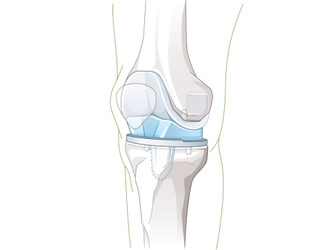 Knieprothese_quer