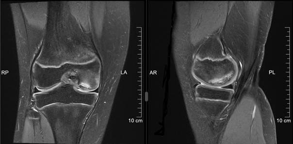 MRI des gleichen Kniegelenks