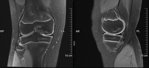 MRI drei Monate nach der Operation