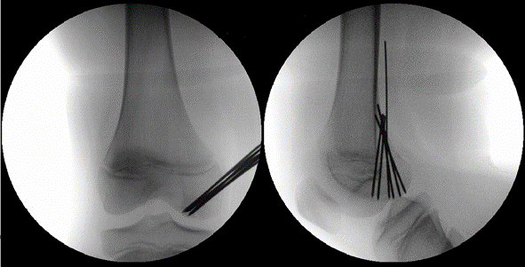 Retrograde Anbohrung der Osteochondrosis dissecans