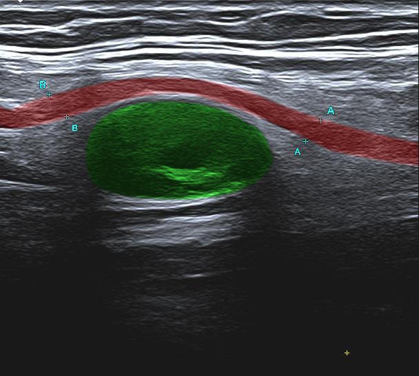 Nervenultraschall (Sono radialis)