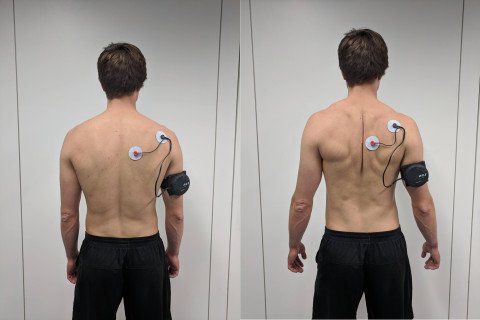 Platzierung der Elektroden des Schulterschrittmachers zur Stimulation der Schultermuskulatur.