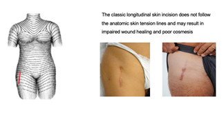 Direct anterior approach (DAA) increasingly used in THR