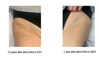 First experience with bikini DAA in 2011
