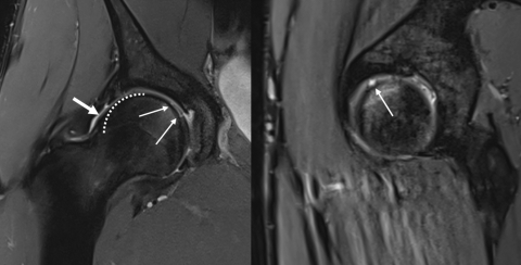 MRI der Hüfte