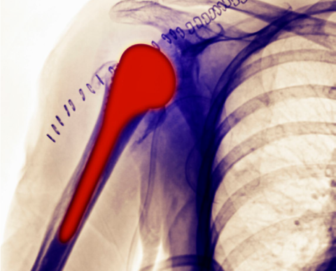 Revision Shoulder Arthroplasty