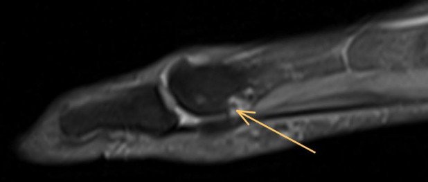 Plantarer Osteophyt