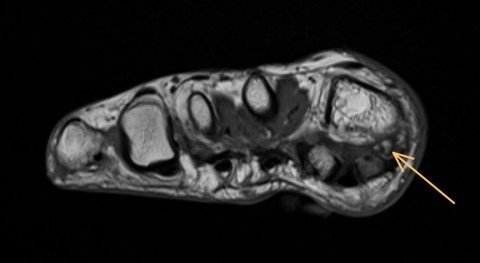 Plantarer Osteophyt