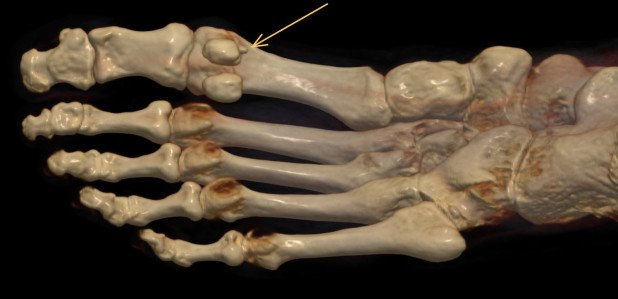 Plantarer Osteophyt