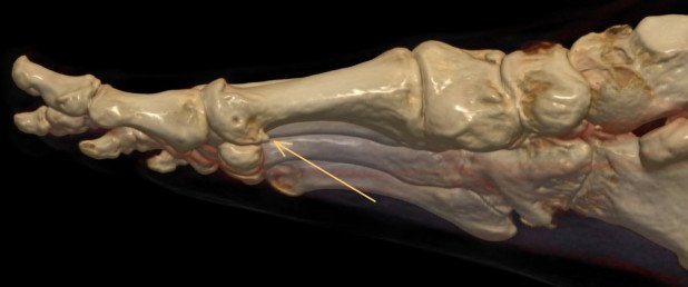 Plantarer Osteophyt