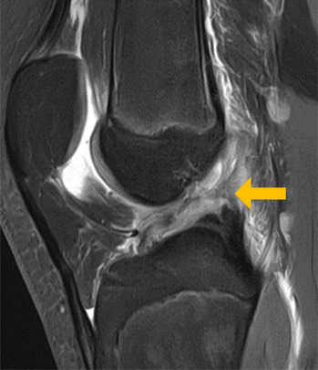 MRI eines Kniegelenkes mit einer Ruptur des vorderen Kreuzbandes