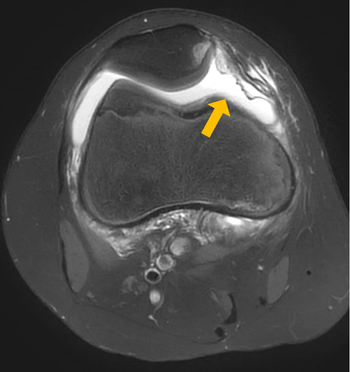 MRI nach einer Kniescheibenluxation