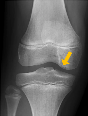 Femur (Oberschenkelknochen)