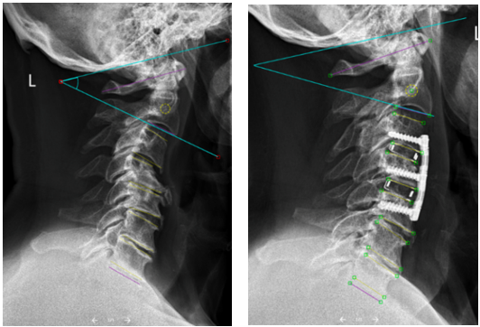 Röntgenbild Wirbelsäule