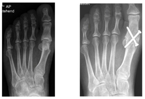 Hallux rigidus