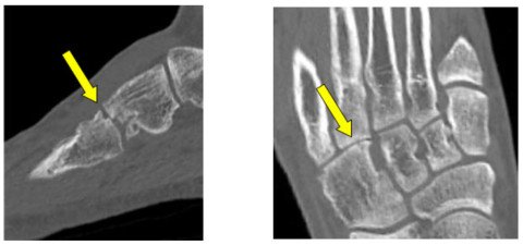 Lisfranc 4 Arthrose