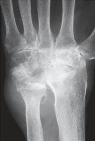 Röntgenbild Schwere Arthrose (zerstörtes Gelenk)