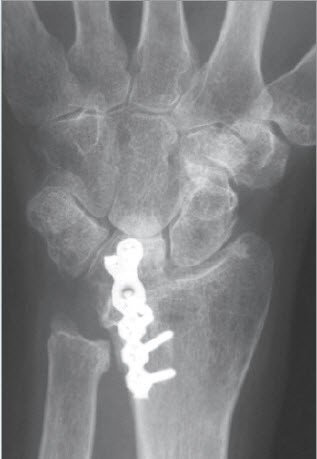 Röntgenbild einer radiolunären Arthrodese