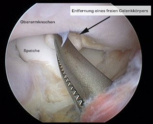 Ellbogenarthroskopie