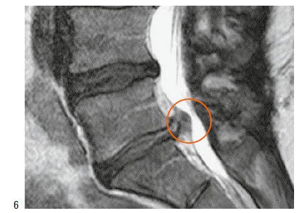 MRI Bandscheibenvorfall