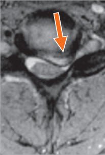 Bandscheibenvorfälle