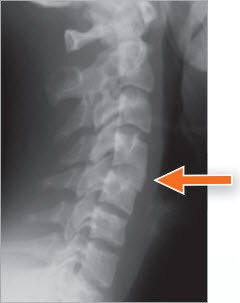 Knochenstück vom Becken