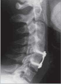 Sicherung mit einer Platte