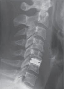 Bandscheibenprothesen