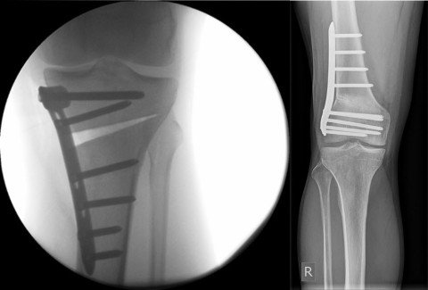 Beinachskorrekturen Begleitpathologien Knorpelschaden