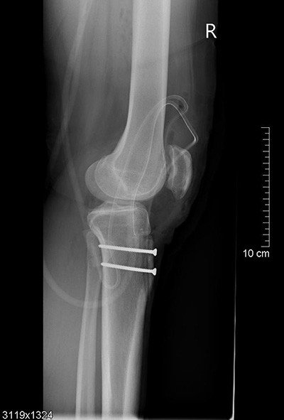 Tuberositas-Osteotomien Knorpelschaden