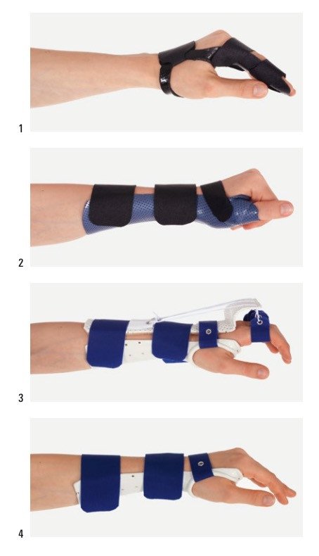Warum Gips nach Ganglion OP?