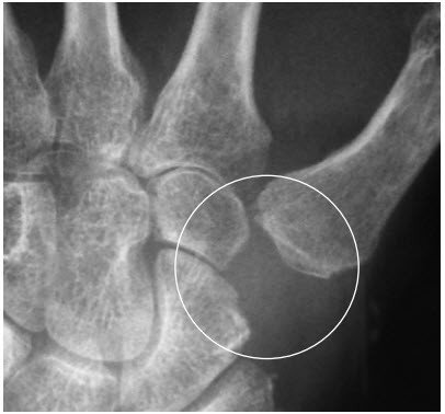 Operation mit Entfernung des Vieleckknochens (Os trapezium)