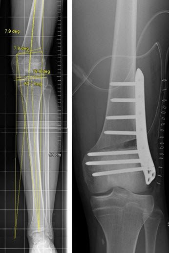 Deformitätenkorrektur mit winkelstabiler Platte OP