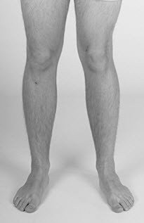 Deformitätenkorrektur mit winkelstabiler Platte vor OP