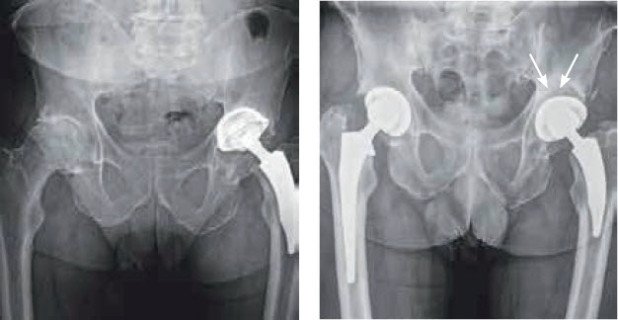 Eigenknochen Transplantation bei Hüftoperation