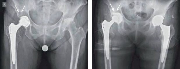 Eigenknochen Transplantation bei Hüftoperation