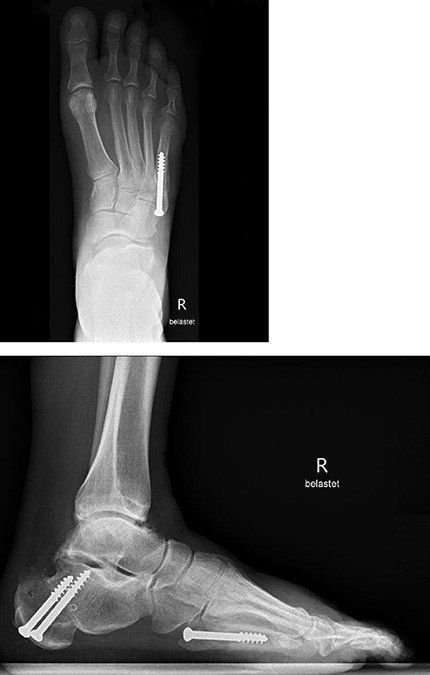 Postoperativ